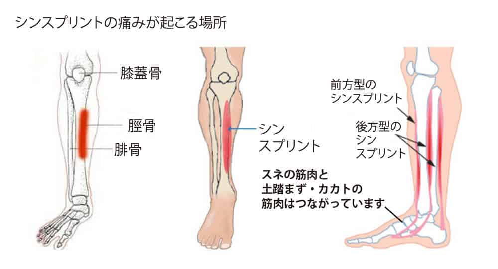 シンスプリント 脛骨過労性骨膜炎 について 姫路市 いろは鍼灸整骨院