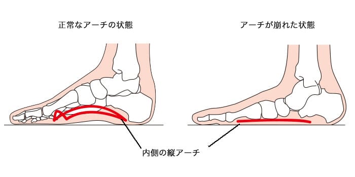 扁平足について 姫路市 いろは鍼灸整骨院